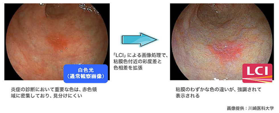 内視鏡検査